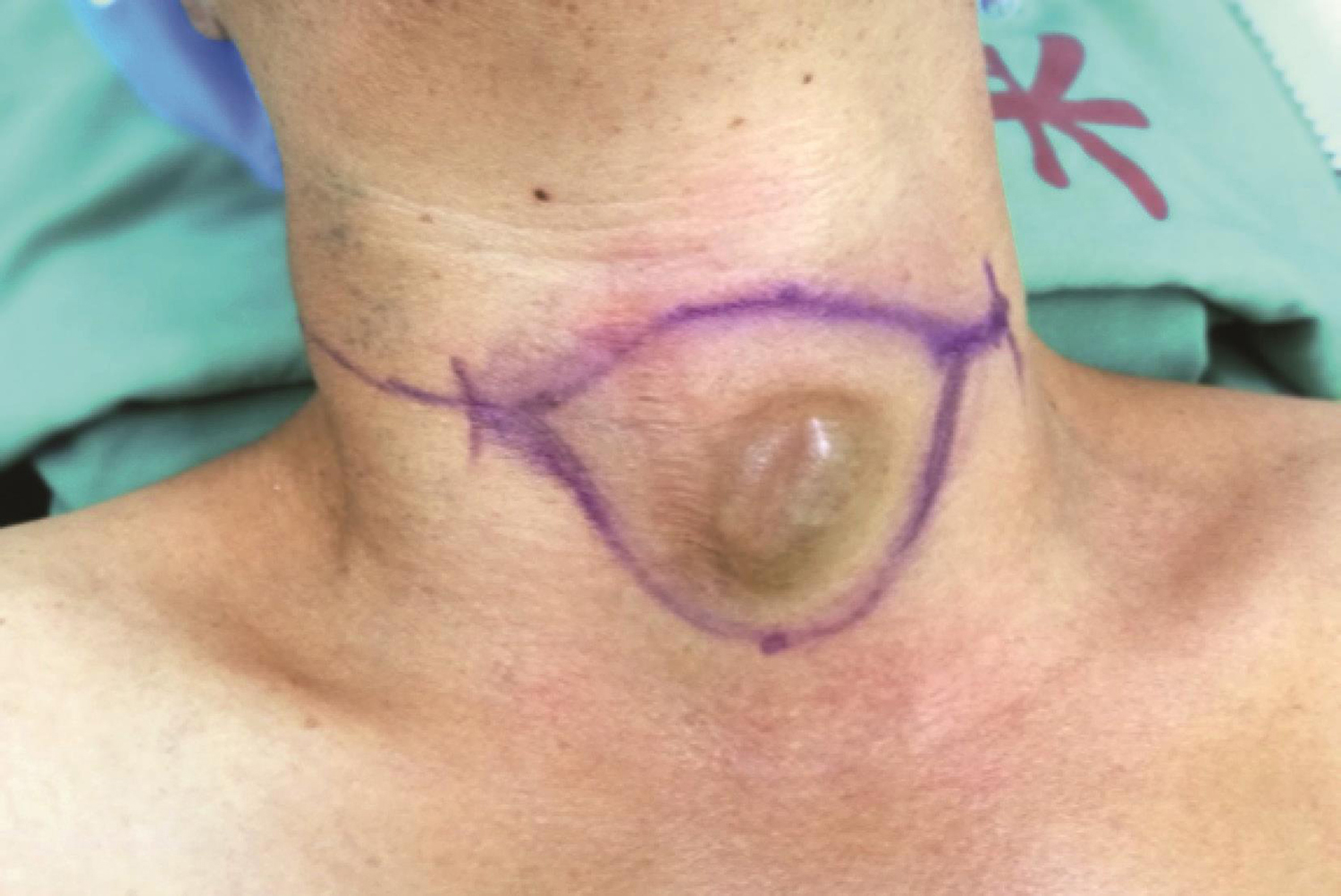 /uploads/image/2025-05-26/162354411图7 颈部切口设计.jpg 图7 颈部切口设计